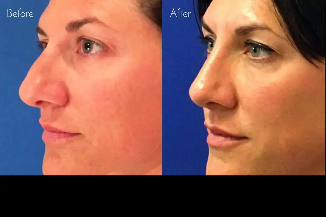 Before & After Photos