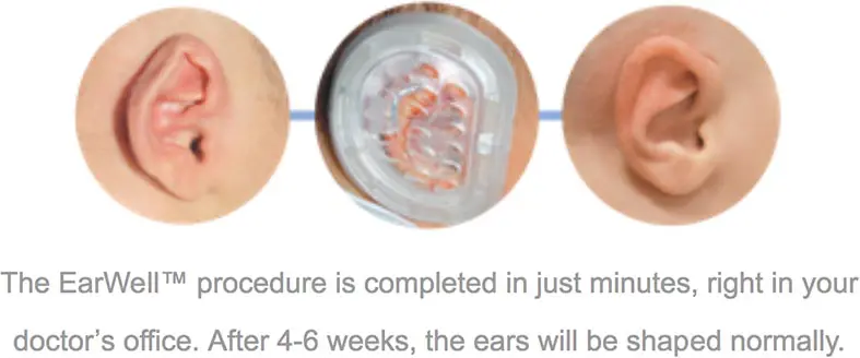EarWell Infant Ear Correction in Poughkeepsie, NY