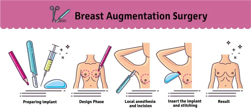 Breast Augmentation in Poughkeepsie, NY