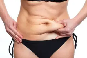 CoolSculpting® in Poughkeepsie, NY