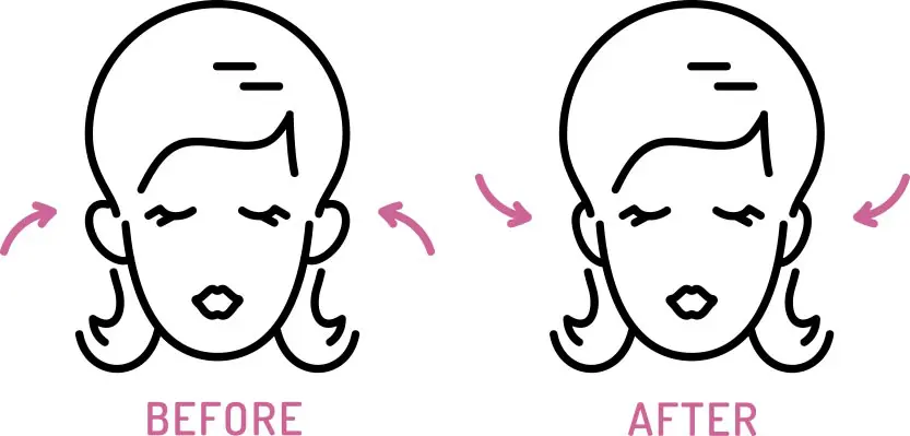 Otoplasty in Poughkeepsie, NY