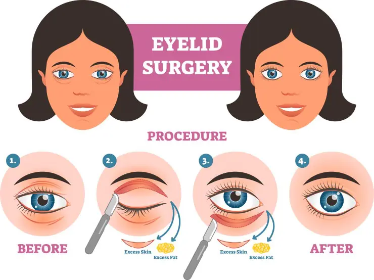 Double eyelid surgery procedure top