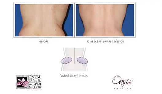 CoolSculpting Before and After Pictures Poughkeepsie, NY