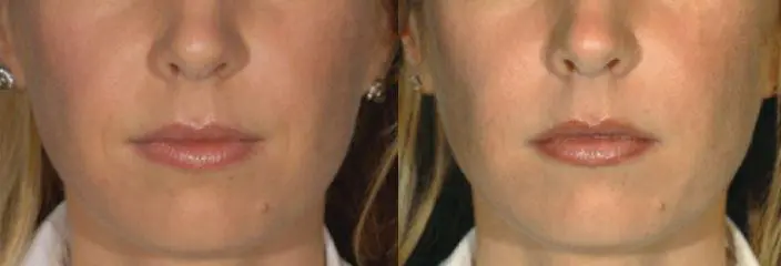 Poughkeepsie Residents Ask: How Do I Choose Between Restylane® and Juvéderm®