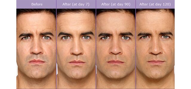 Botox Before and After Pictures Poughkeepsie, NY