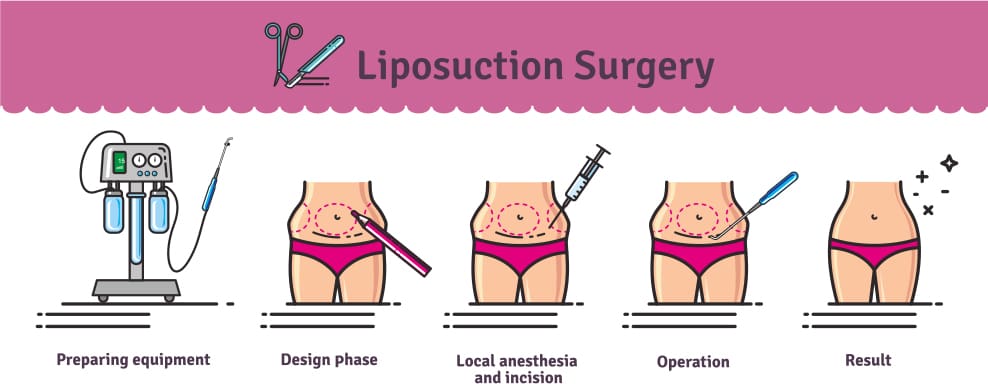 Liposuction in Poughkeepsie, NY