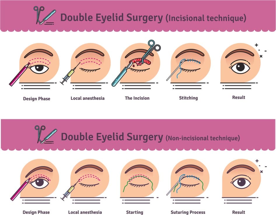 Asian Eyelid Surgery in Poughkeepsie, NY