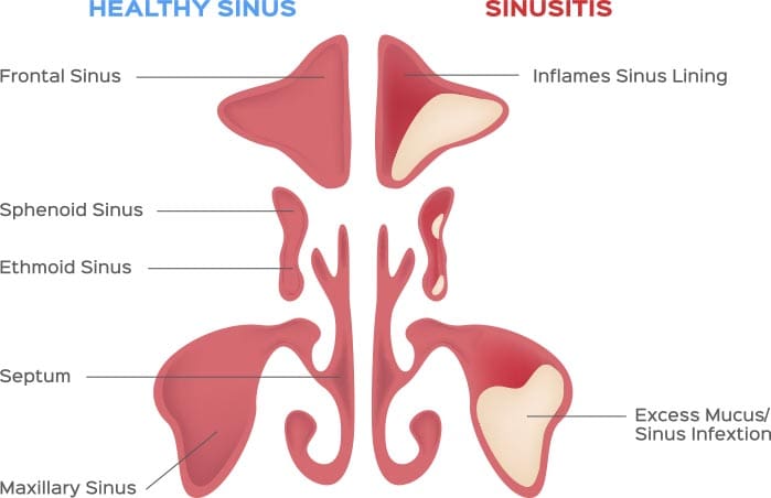 Sinus Surgery in Poughkeepsie, NY