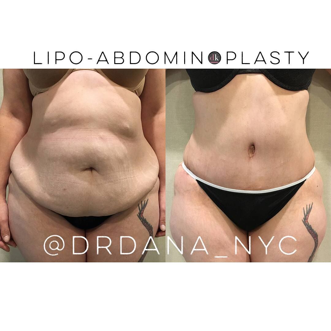 Tummy Tuck (Abdominoplasty) In NYC - Joshua BHyman M.D.