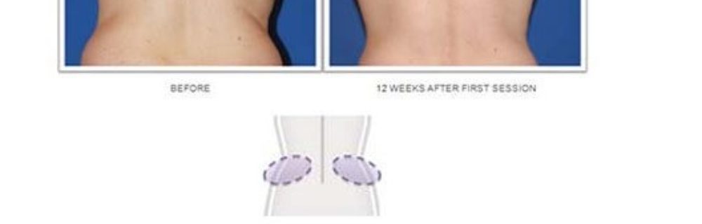 Poughkeepsie Residents Ask: Do CoolSculpting Results Last?