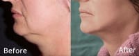 Microneedling Before and After Pictures Poughkeepsie, NY
