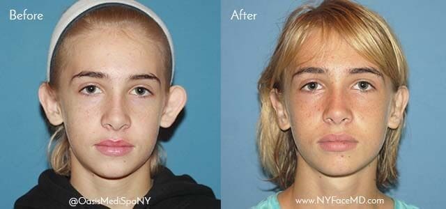 Otoplasty / Ear Reshaping Before and After Pictures Poughkeepsie, NY