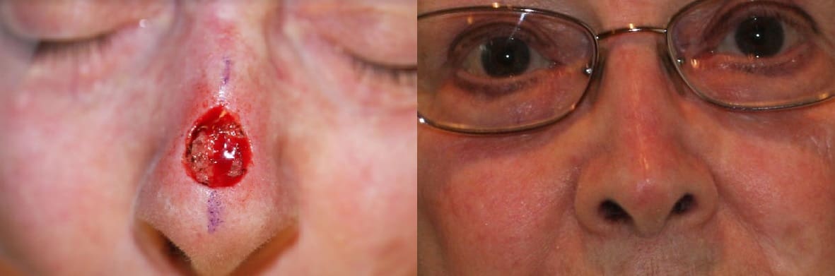 Skin Cancer Reconstruction Before and After Pictures Poughkeepsie, NY