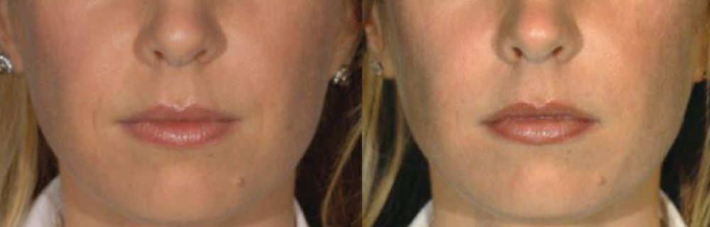 Poughkeepsie Residents Ask: How Do I Choose Between Restylane® and Juvéderm®