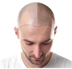 Scalp Micropigmentation in Poughkeepsie, NY