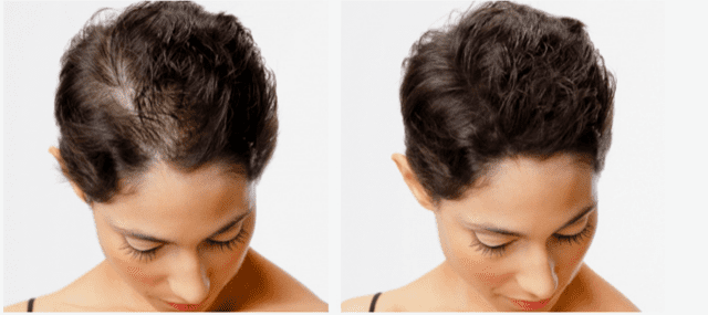 Scalp Micropigmentation in Poughkeepsie, NY | Facial Plastic Reconstructive & Laser Surgery Scalp Micropigmentation in Poughkeepsie, NY | Facial Plastic Reconstructive & Laser Surgery