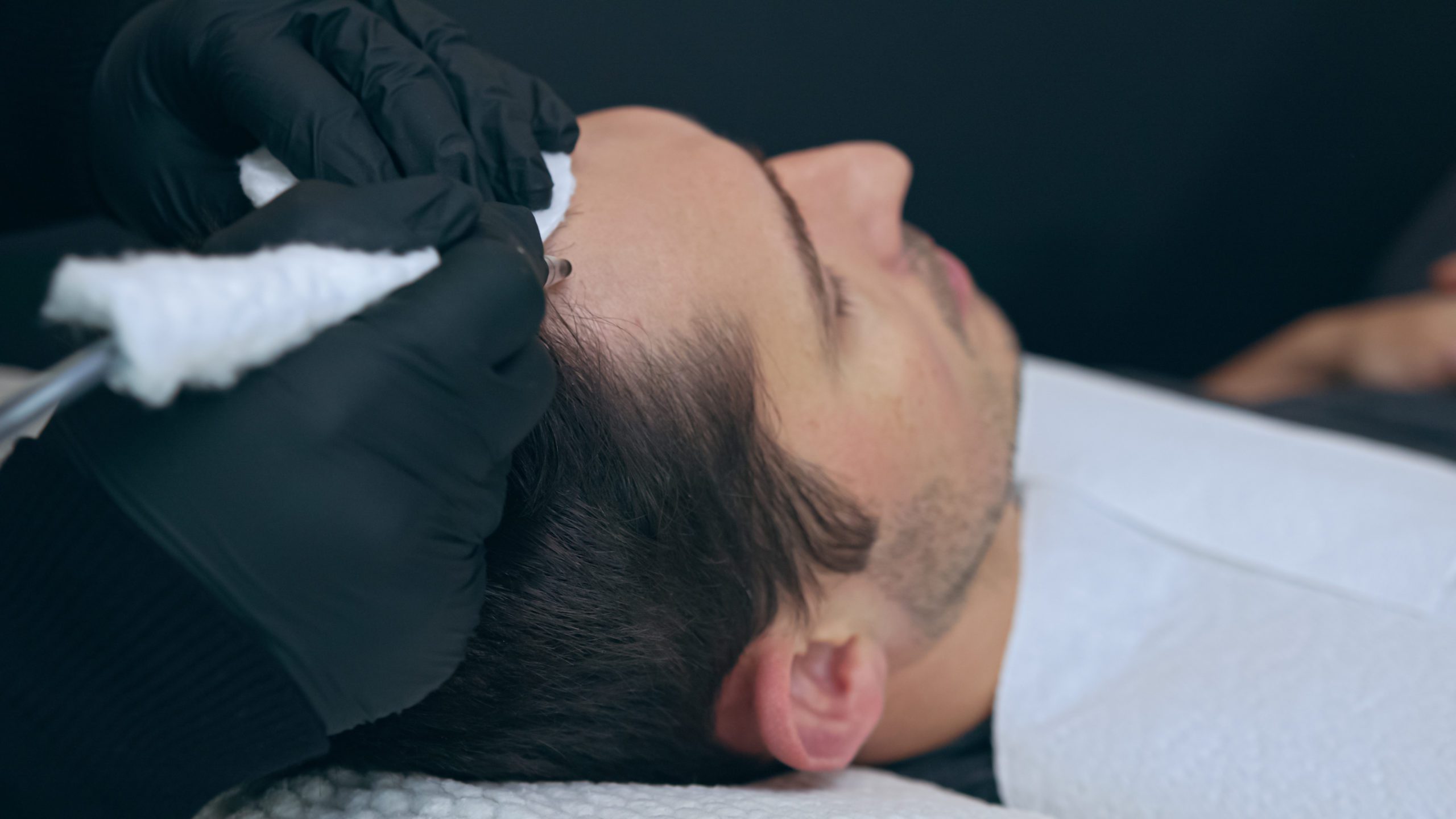 Scalp Micropigmentation in Poughkeepsie, NY Facial