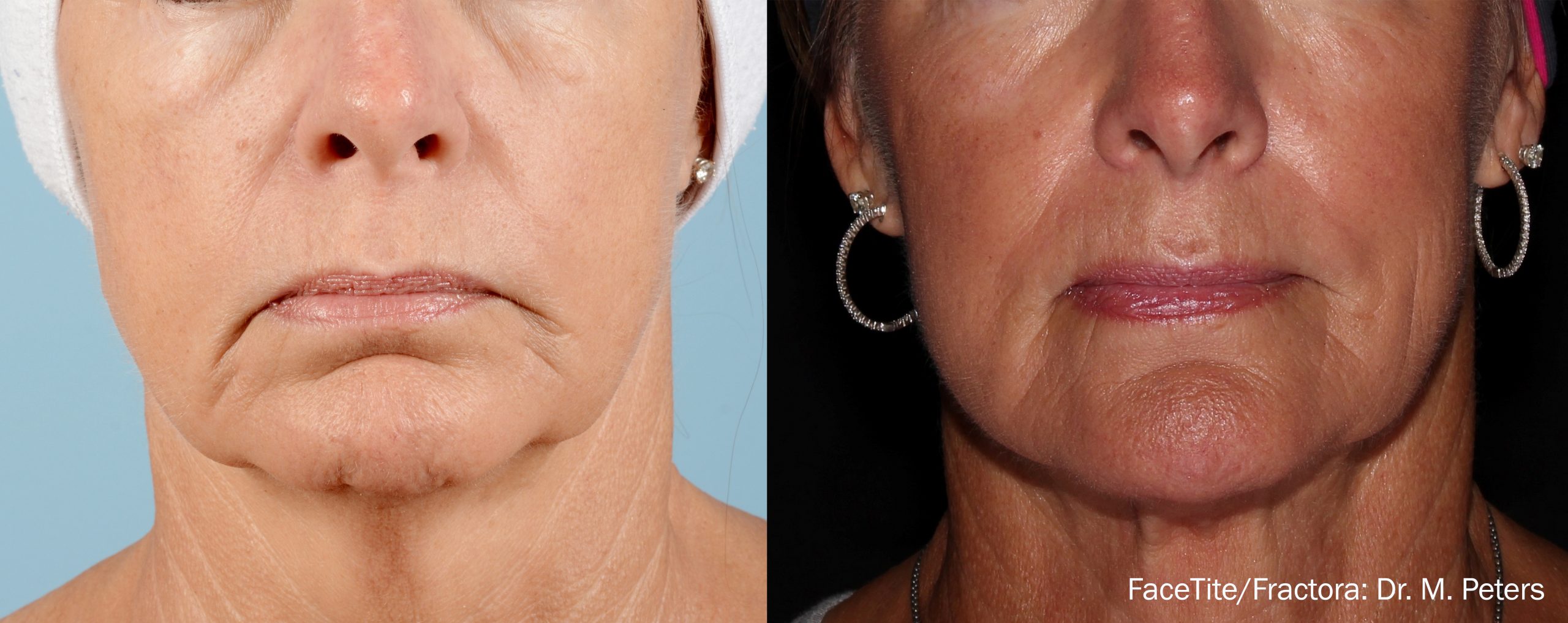 FaceTite in Poughkeepsie, NY | Facial Plastic Reconstructive & Laser ...